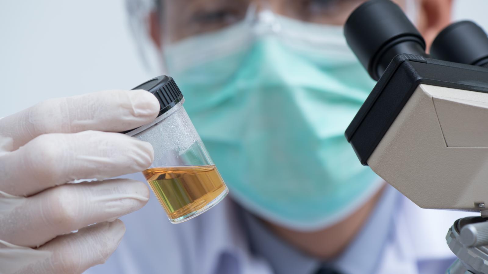 A blurry picture of a medical specialist wearing face and on his right hand is urine in a sample container