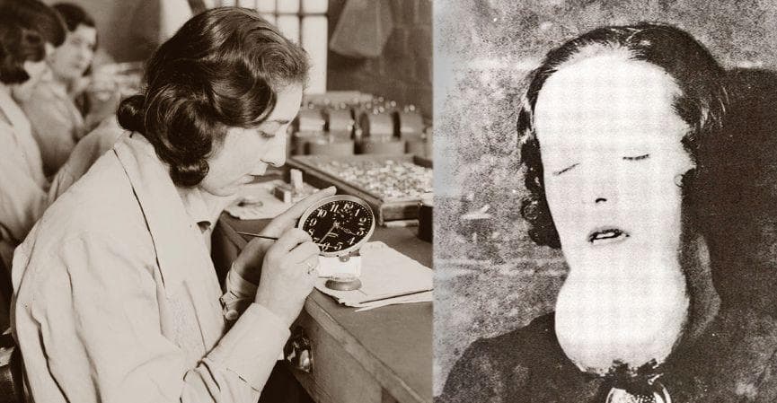 Radium Girls Were Badly Poisoned By Radium Jaw Disease