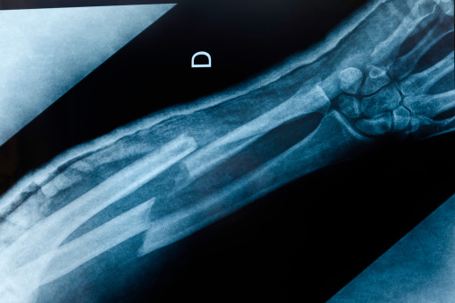 The ulna and radius are fractured in this X-ray image of the forearm taken from the AP (anteroposterior) perspective