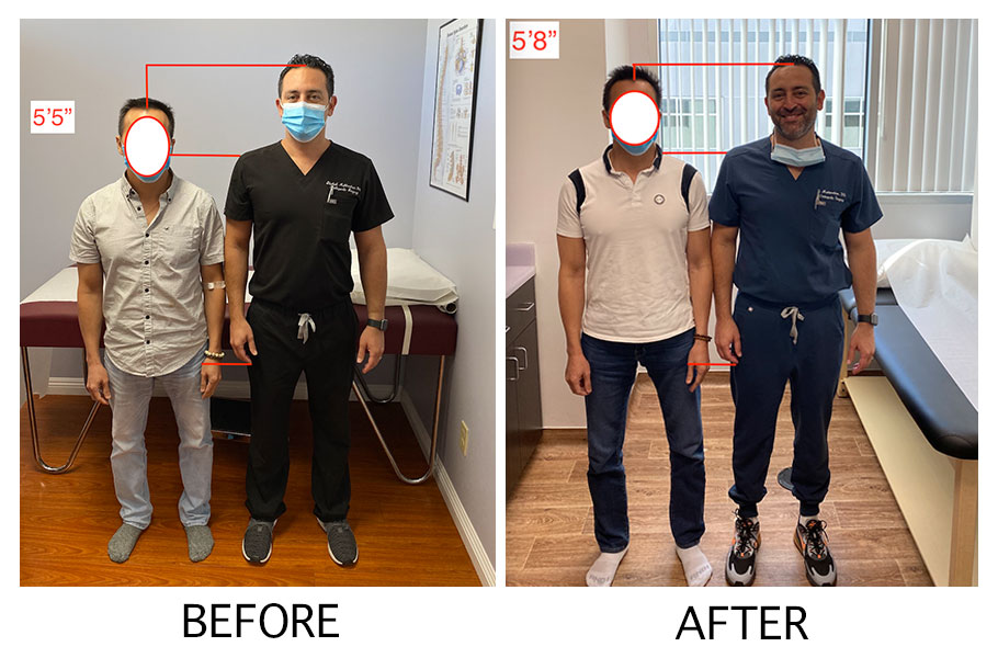  a patient whose height is increased due to limb lengthening surgery