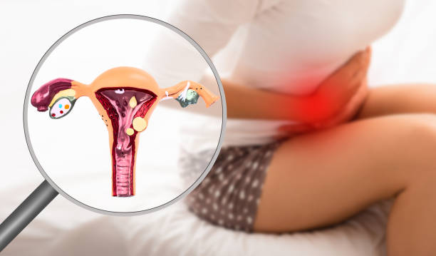 A woman suffering from endometriosis pain while on the bed with a close-up uterine virtual model