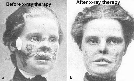 Radium jaw treatment of a lady with X-ray therapy