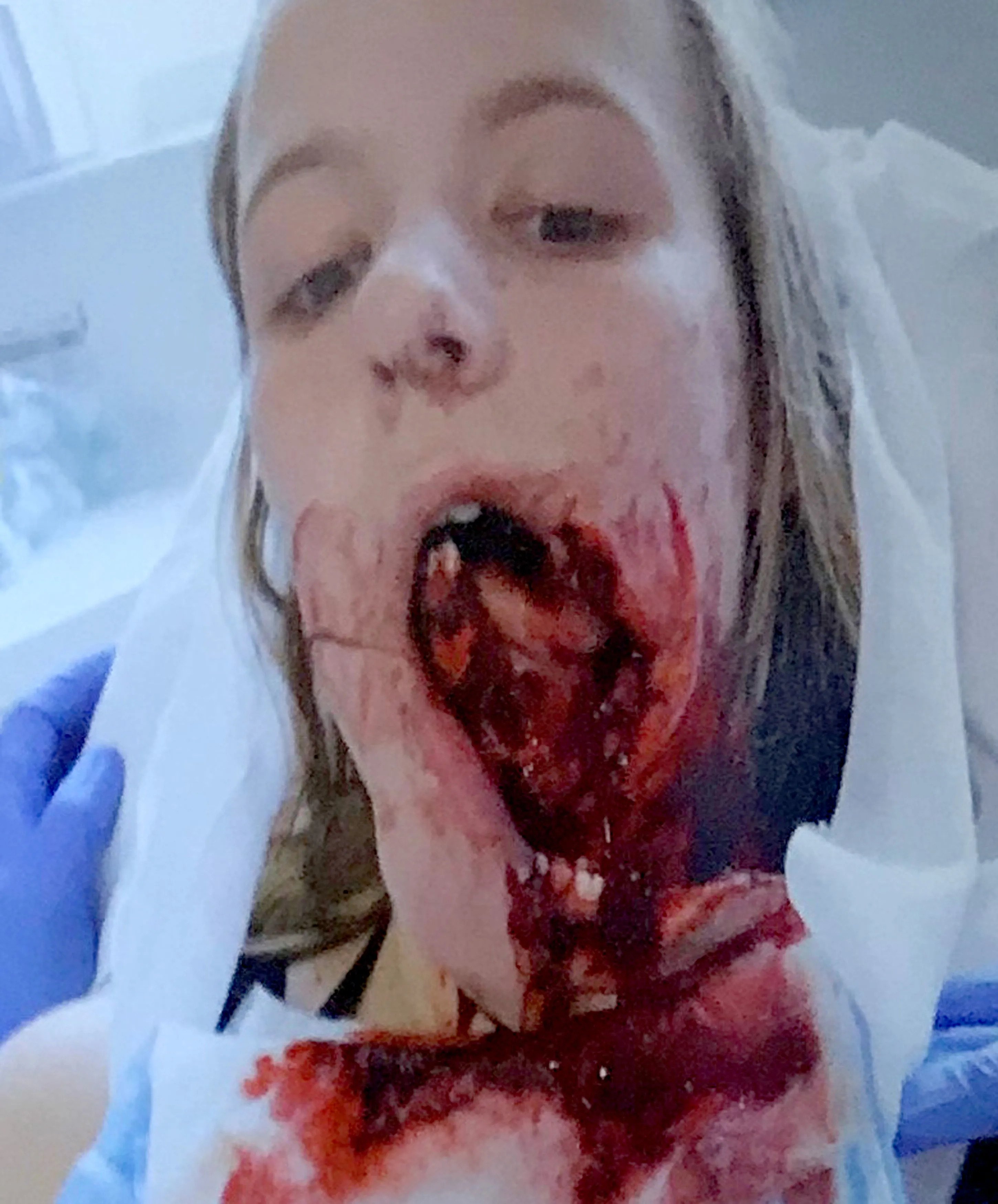 Half broken jaw of Emily Eccles
