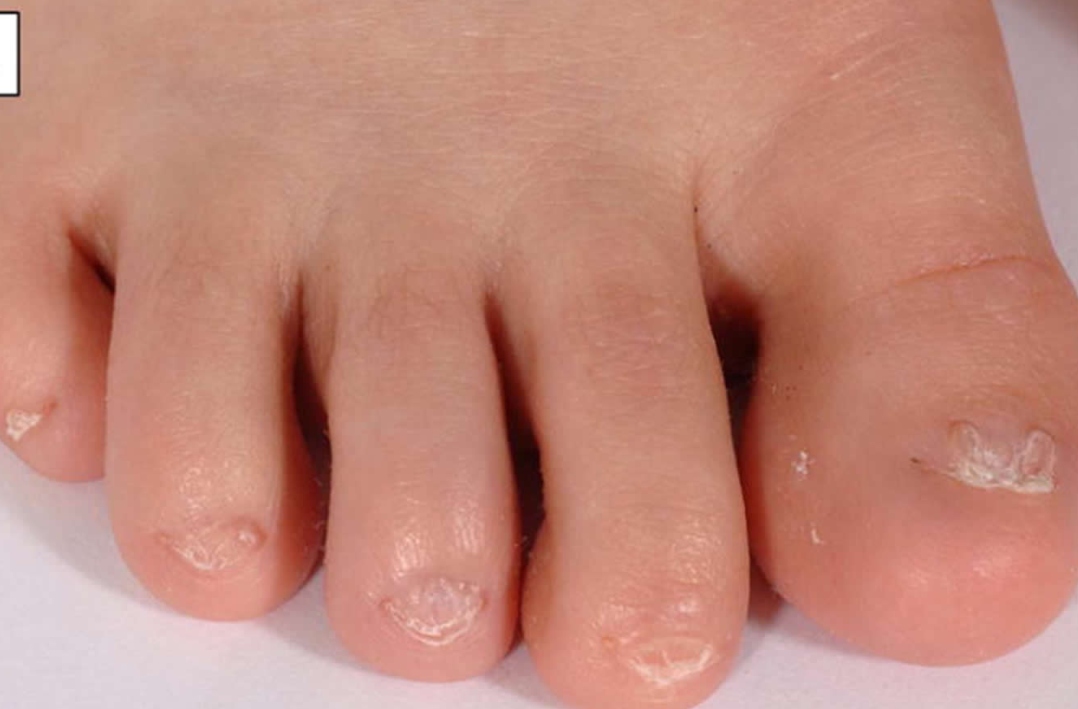 Foot suffering from anonychia disease