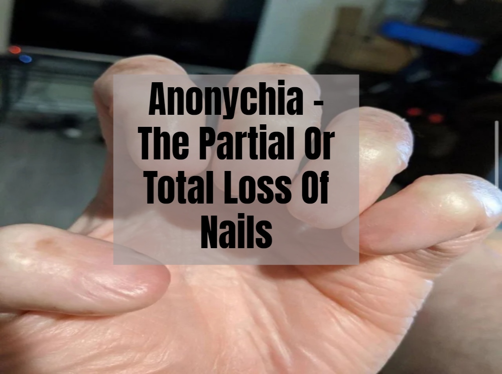 Anonychia - The Partial Or Total Loss Of Nails