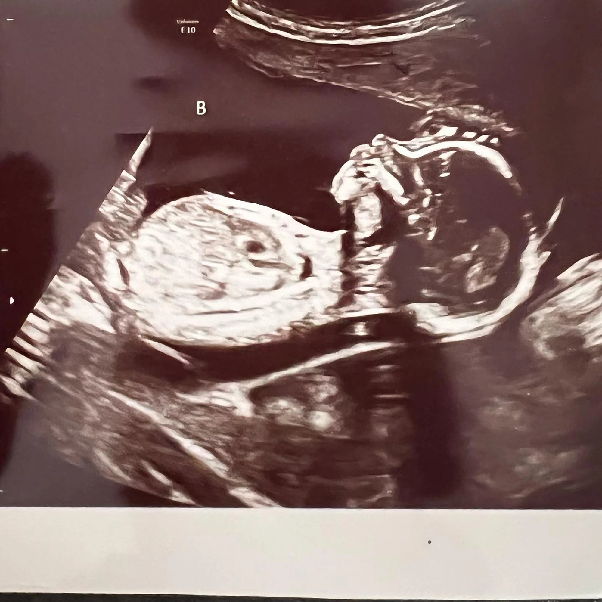 The two set twins ultrasound