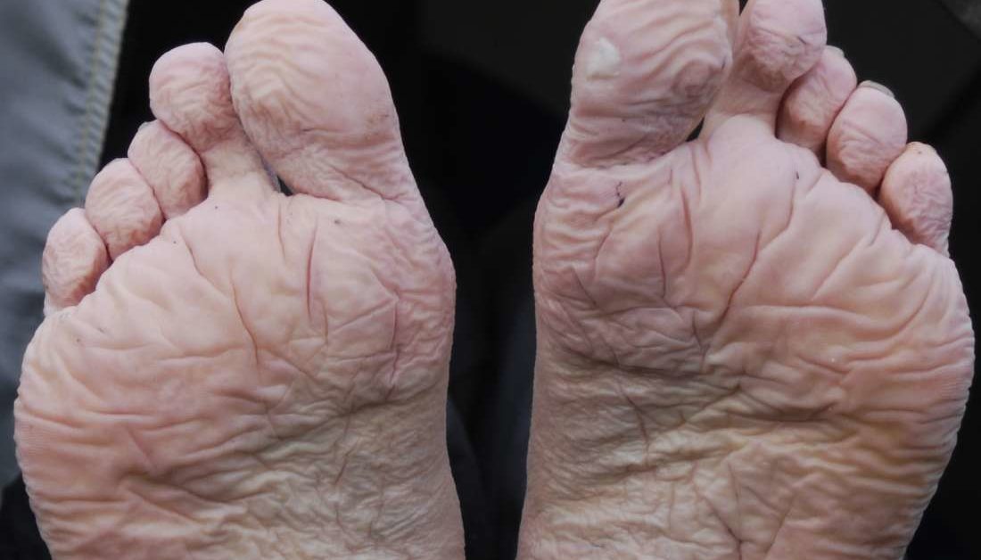 Feet with wrinkled skin and numerous veins that form after being wet for extended period of time