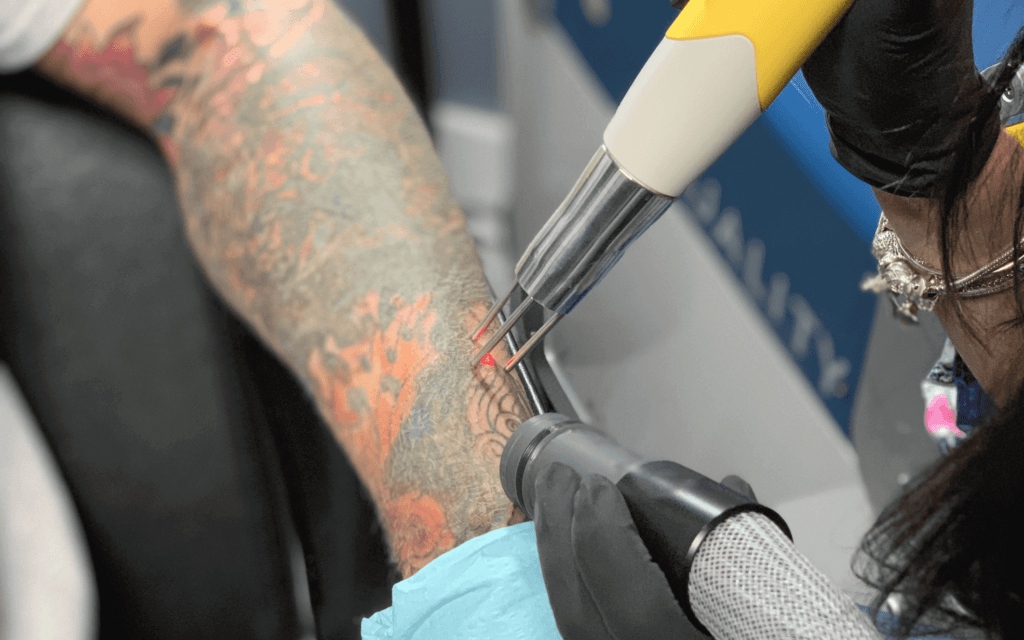 A specialist removing tattoo from the arm using laser machine