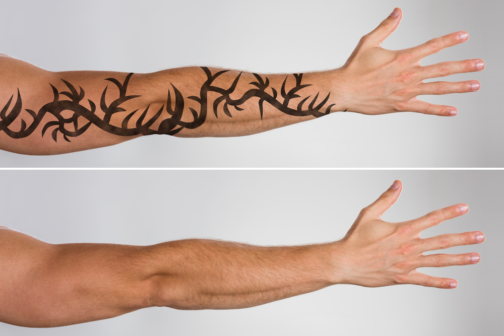 A man's arm with tattoo and without tattoo