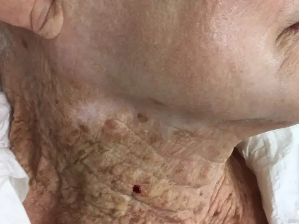 A close up view of the extreme sunburn of an old lady's neck