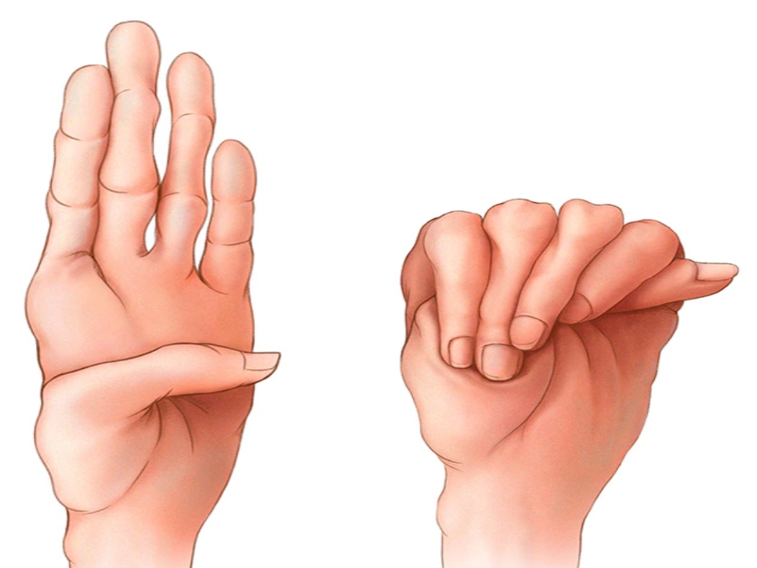 A drawing of hands suffering from Marfan syndrome