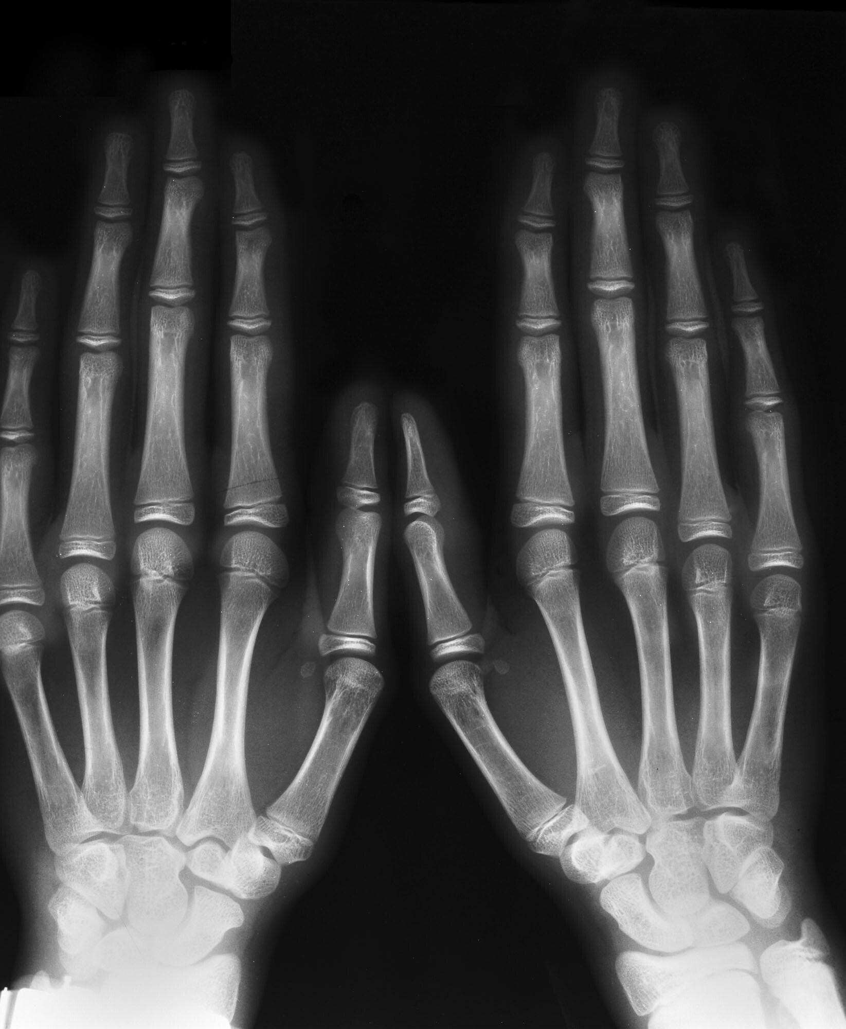 Marfan Syndrome - This Is Why Some People Have Abnormally Longer Fingers