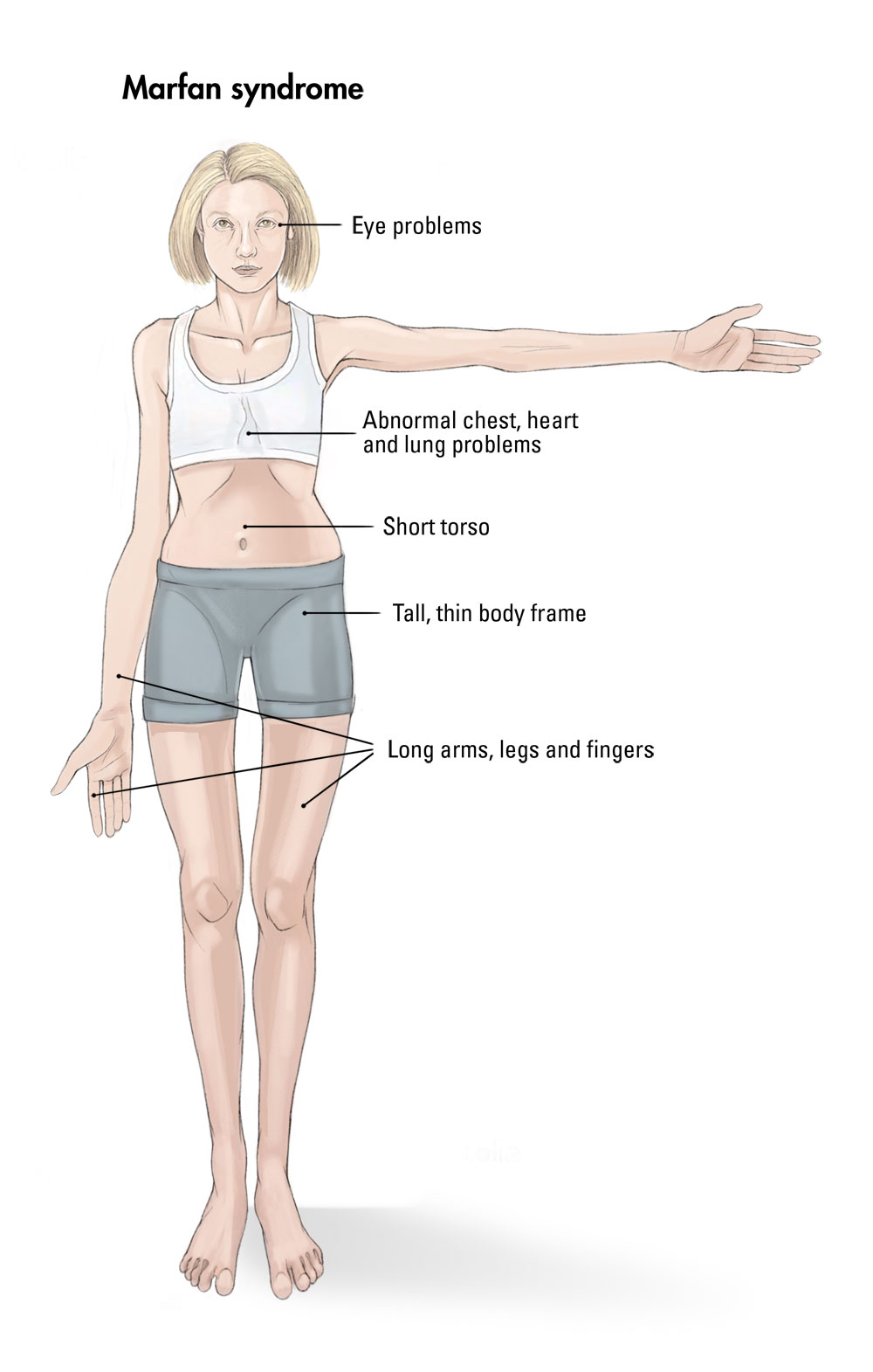 A drawing of a girl showing symptoms of marfan syndrome