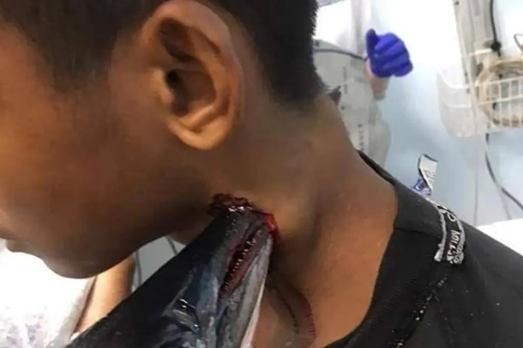 Indonesian Teen Lucky To Be Alive After Being Speared Through The Neck By Fish