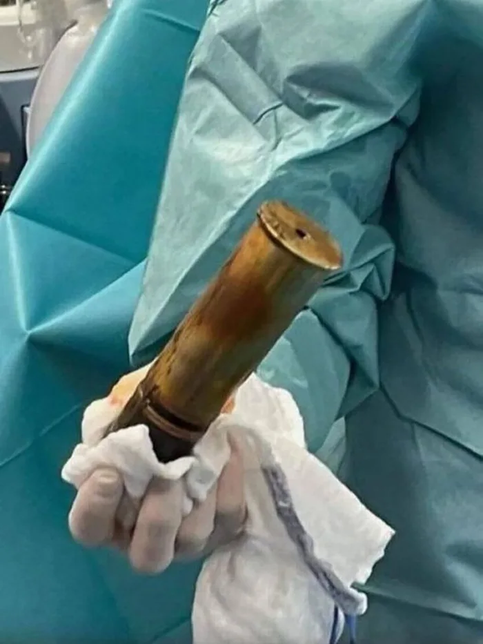 Man Who Came In With WWI Explosive Stuck In His Rectum Causes Hospital To Evacuate In France