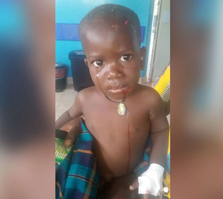 A naked two-year-old boy shows his hand plastered with white and several marks on his head