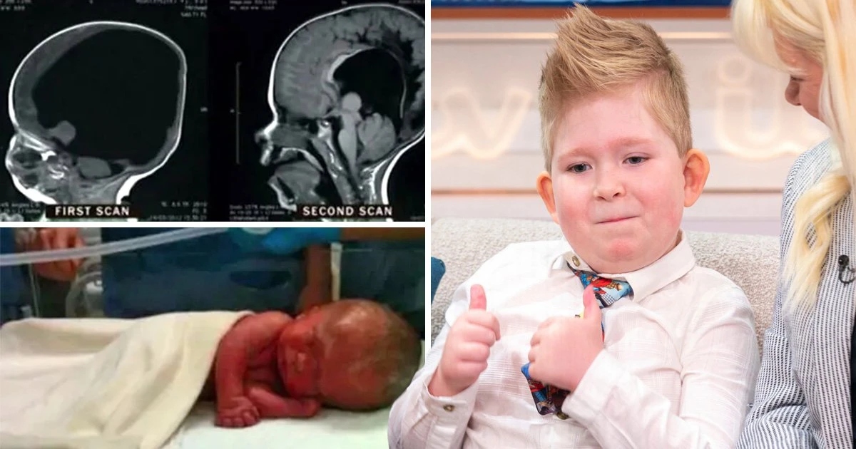 Miracle Boy Born With No Brain Defies The Odds As His Brain Grows Back
