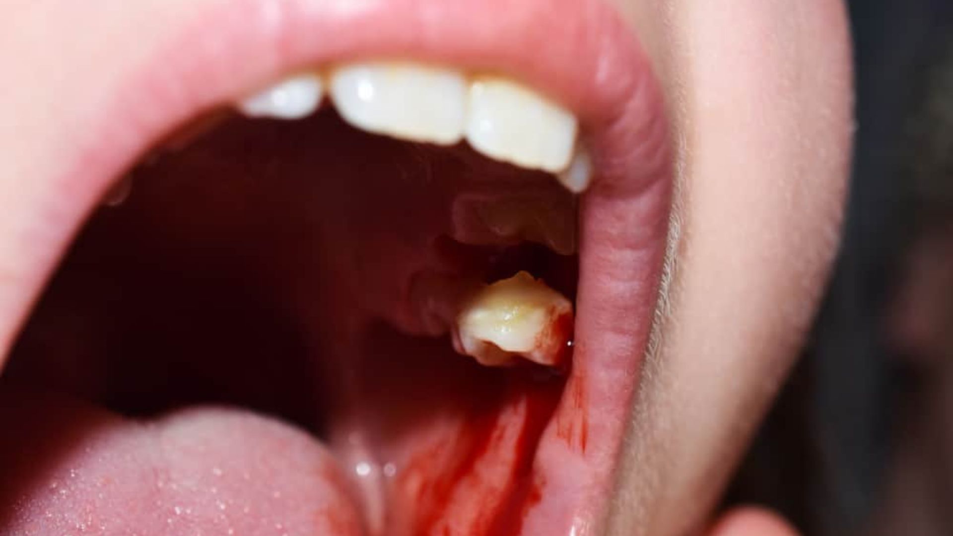 Blood From Child's Teeths