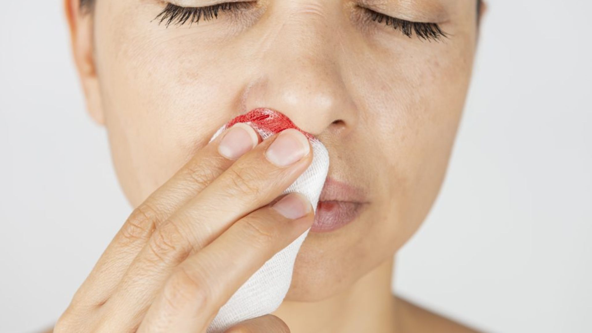 A Woman Covering Her Bleeding Nose With A Tissue