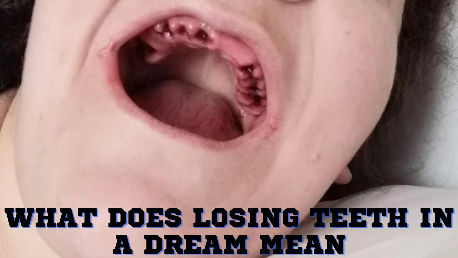 What Does Losing Teeth In A Dream Mean?