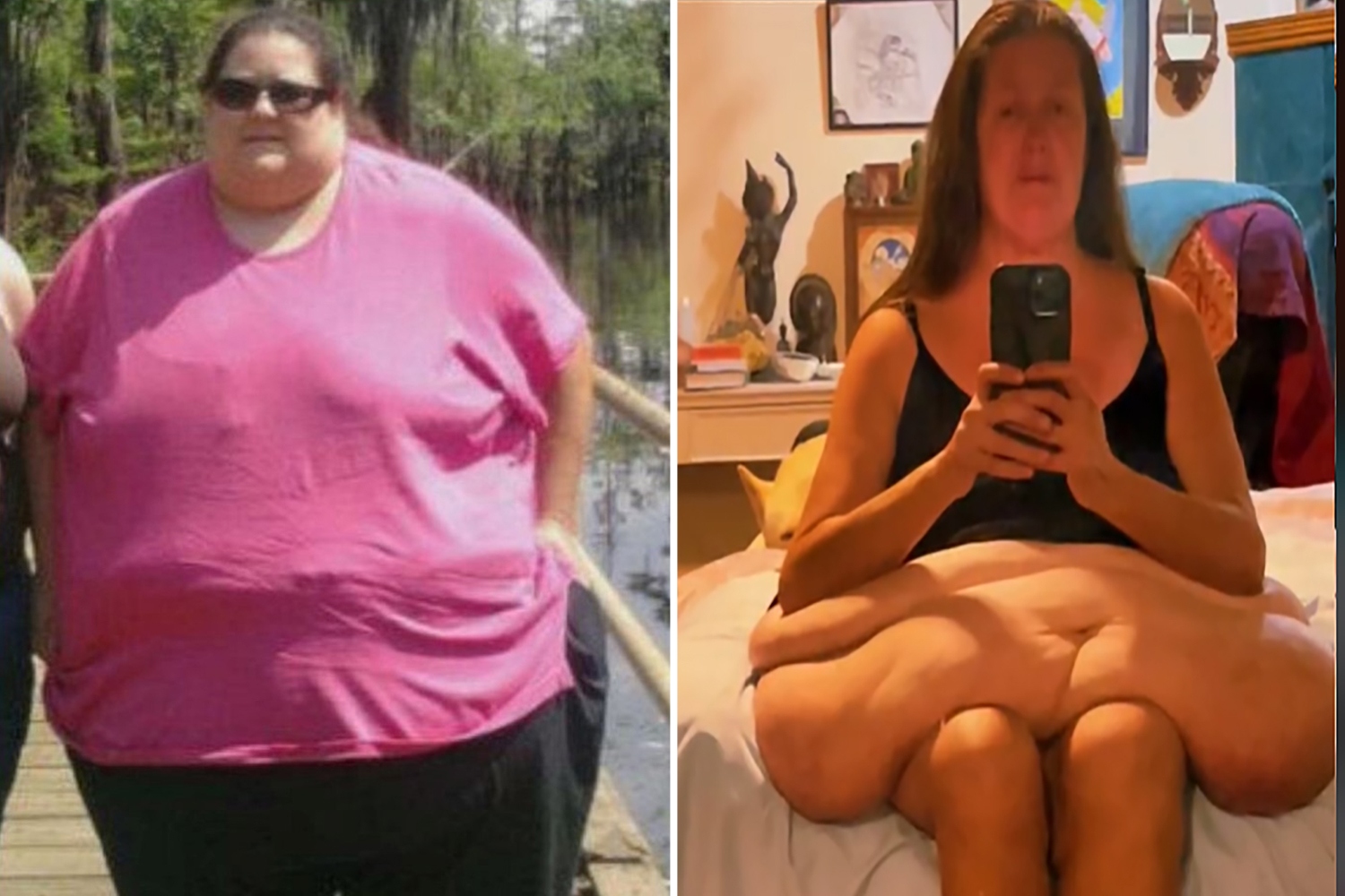 Woman Who Lost Almost 417 Pounds Undergoes Surgery To Get Rid Of 47 Pounds Of Excess Skin