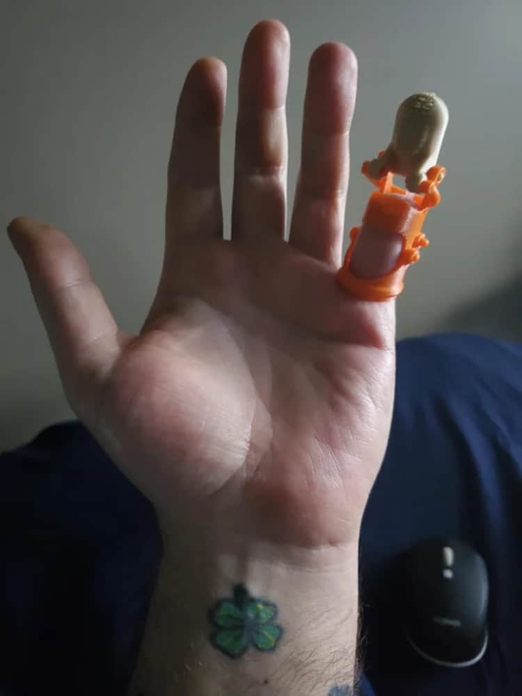 Reddit Helps Man Obtain New Prosthesis For His Pinkie Finger