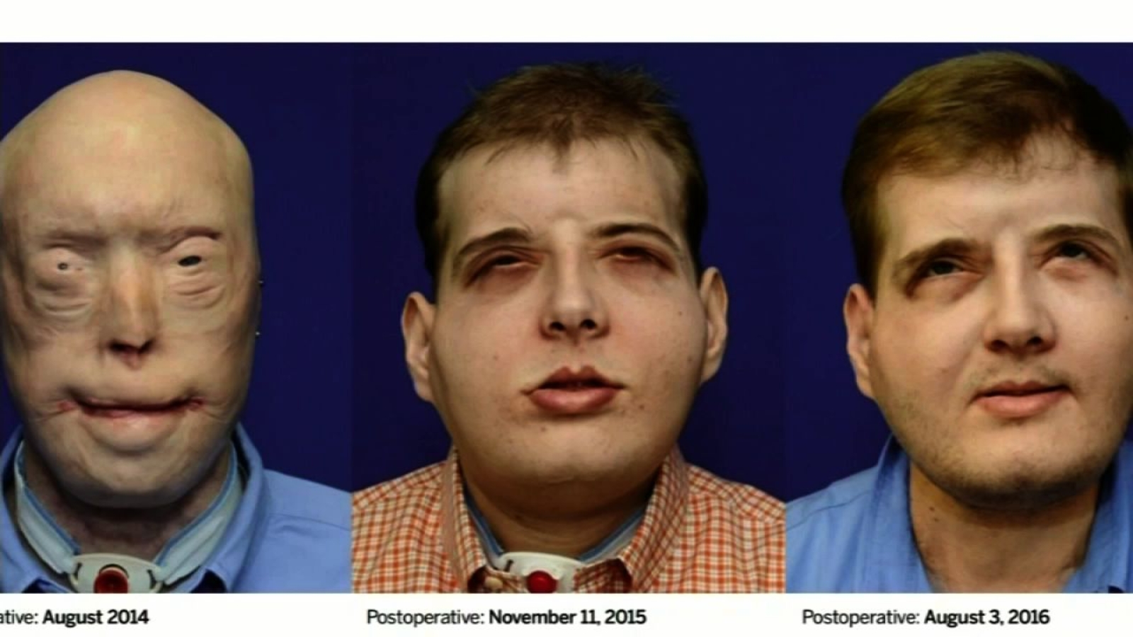 Firefighter Who Injured His Face Completely In Fire Undergoes Historic Face Transplant