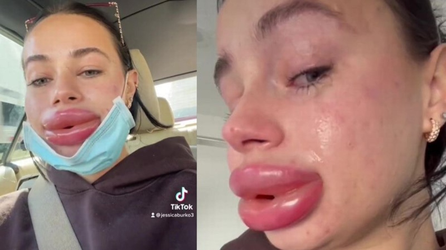 Woman Warns About 'Free Cosmetic Work' Done As Her Lips Grew Painfully Big