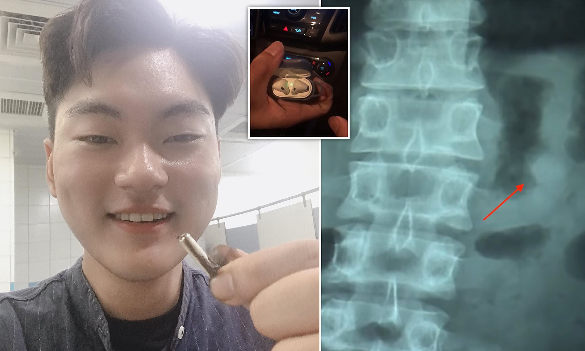 Man Accidentally Swallows AirPod, Finds It Still Works After Passing It