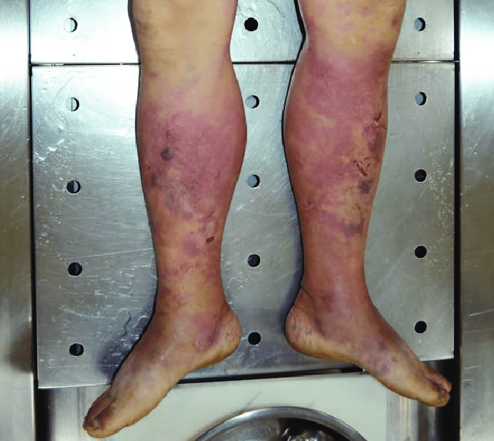 Blisters and Erythematous Lesions on Both Legs Caused by Vibrio Vulnificus Infection
