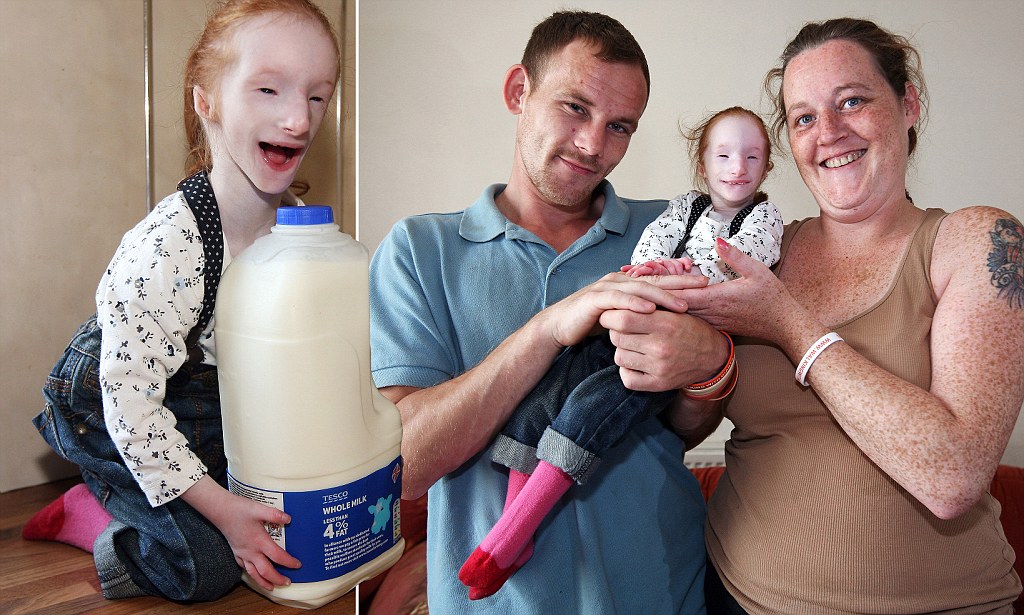 Charlotte Garside - World's Smallest Girl Who Is Suffering From Primordial Dwarfism