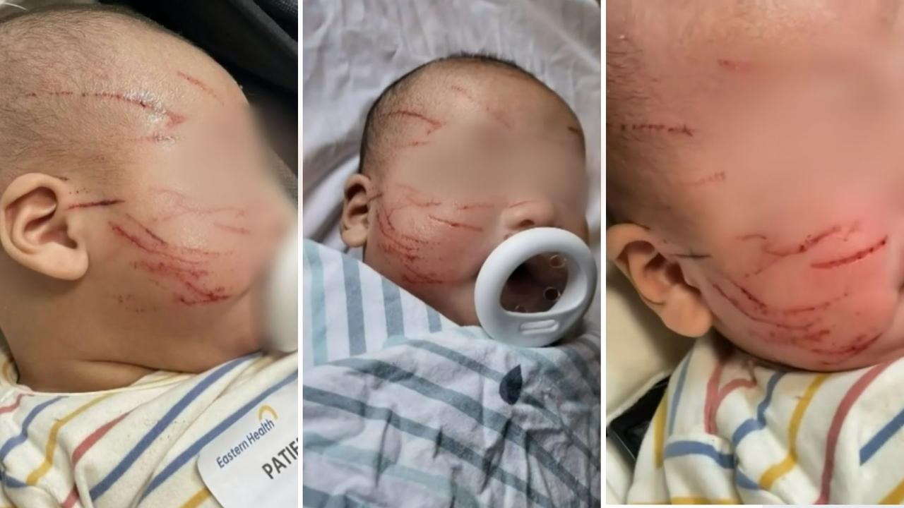 Mother Discovers Baby With 20 Face Scratches In Melbourne Childcare