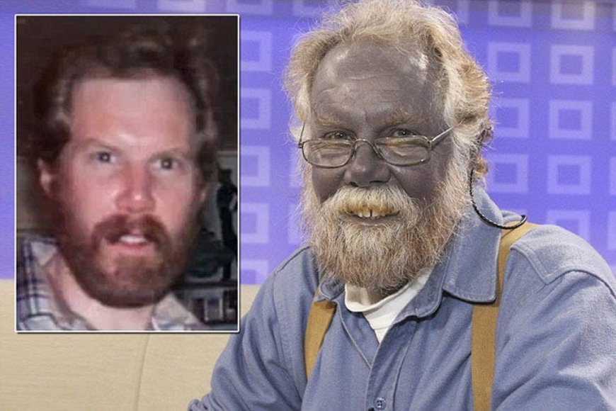 Strange Case Of The Man Dubbed 'Papa Smurf' Who Turned Himself Blue Forever