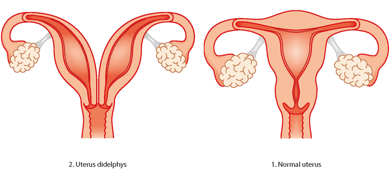 Normal Uterus vs Double Uterus